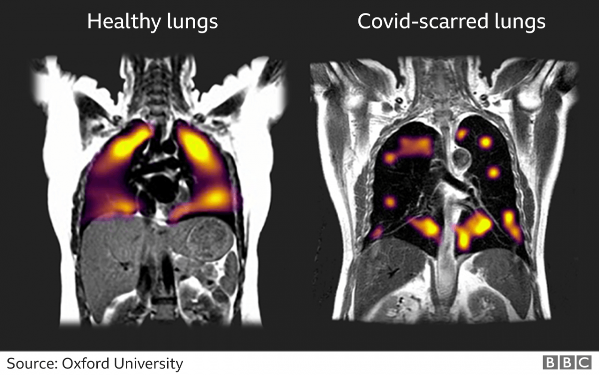 Темні ділянки – ті частини легенів, де повітря насилу транспортується в кров. Перший знімок – здорові легені, другий – пошкоджені коронавірусом. Джерело: BBC