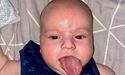 Львівські хірурги «Охматдиту» вкоротили дитині язика, який був уп’ятеро довшим від нормального