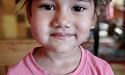 Львівські лікарі без операції вилікували 5-річній дівчинці патологію обличчя