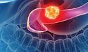Як вчені обдурили рак підшлункової залози!