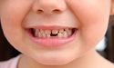 Здорові молочні зубки – запорука гарної усмішки у майбутньому