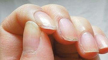 Ламкими нігті можуть стати та­кож, якщо в організмі бракує вітамі­ну B12. Фото з відкритих джерел