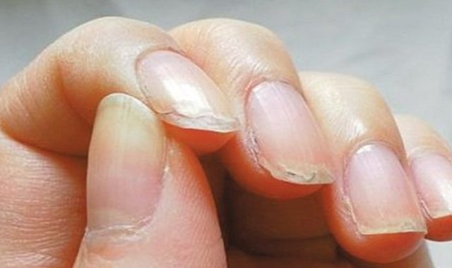 Ламаються та розшаровуються нігті: чого не вистачає організму?